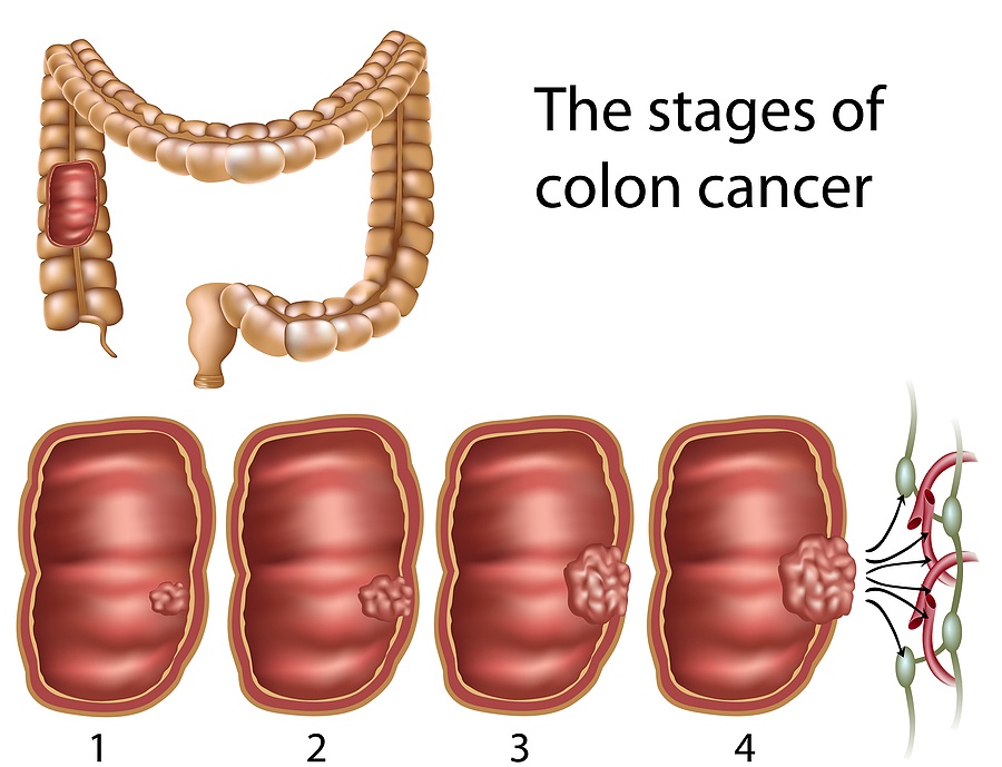 bigstock_Colon_cancer_18025796.jpg
